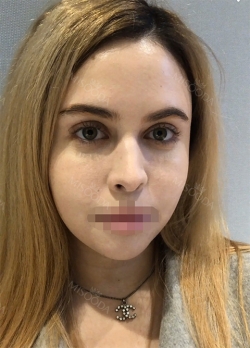 Great service doing Ulthera , Botox and Lip fillers using Misooda — Korea cost, reviews & before-after | MISOODA