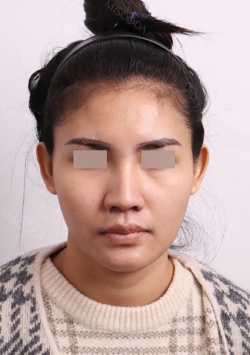 Nose, Fat inject — Korea cost, reviews & before-after | MISOODA