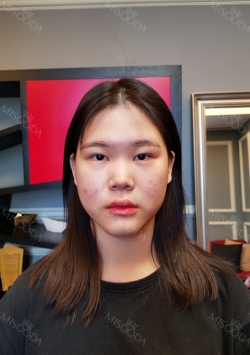 Nose, Eye, Fat inject — Korea cost, reviews & before-after | MISOODA