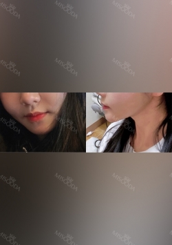 Facial liposuction, Thread Lifting — Korea cost, reviews & before-after | MISOODA