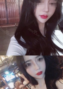 Chin Liposuction — Korea cost, reviews & before-after | MISOODA