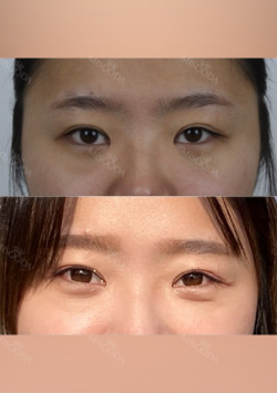 Double eyelids revision : 2 weeks at REN! — Korea cost, reviews & before-after | MISOODA