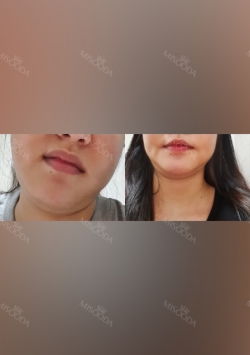 Facial liposuction, Thread Lifting — Korea cost, reviews & before-after | MISOODA