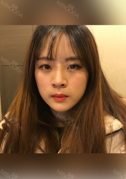 Nose, Eye, Fat Graft After 1 year!!! — Korea cost, reviews & before-after | MISOODA