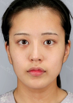 Facial Contour, Chin Reduction, Fat Graft ~!! — Korea cost, reviews & before-after | MISOODA