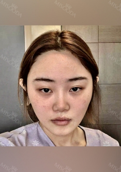Facial Contour + Revision Nose Surgery — Korea cost, reviews & before-after | MISOODA