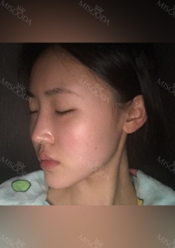 Facial Contour, Chin Reduction, Nose&Eye Surgery After 2 years — Korea cost, reviews & before-after | MISOODA