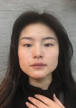 3 in 1 Facial Contouring — Korea cost, reviews & before-after | MISOODA