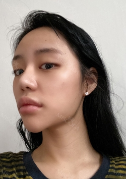 New V-line — Korea cost, reviews & before-after | MISOODA