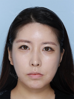 Two jaw surgery !