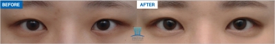MARBLE Plastic Surgery,Reviews,Images, Promotions — Korea cost, reviews & before-after | MISOODA