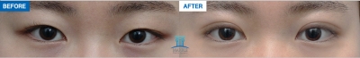 MARBLE Plastic Surgery,Reviews,Images, Promotions — Korea cost, reviews & before-after | MISOODA