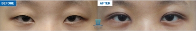 MARBLE Plastic Surgery,Reviews,Images, Promotions — Korea cost, reviews & before-after | MISOODA