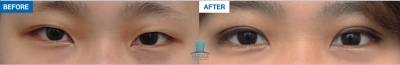 MARBLE Plastic Surgery,Reviews,Images, Promotions — Korea cost, reviews & before-after | MISOODA
