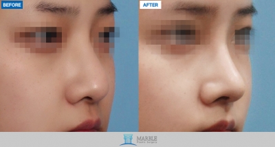 MARBLE Plastic Surgery,Reviews,Images, Promotions — Korea cost, reviews & before-after | MISOODA
