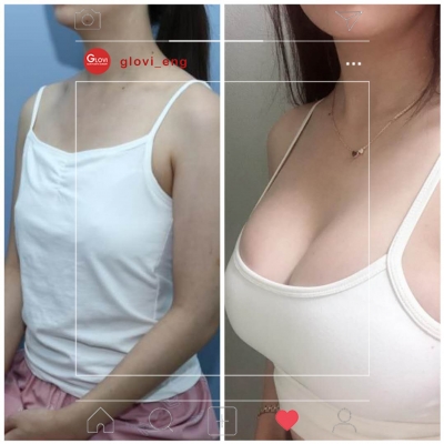 Glovi Plastic Surgery, Reviews, Images, Promotions, Dr. Rho Bongil, Dr. Nam Sangjae, Dr. Park Jongchul — Korea cost, reviews & before-after | MISOODA