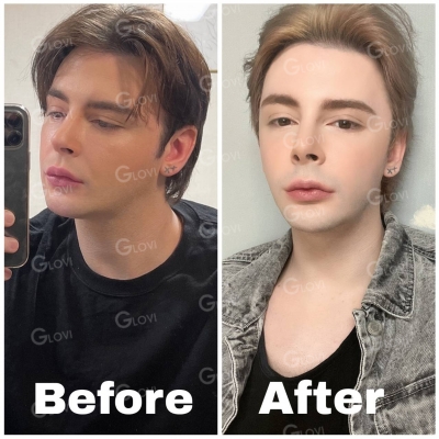 Glovi Plastic Surgery, Reviews, Images, Promotions, Dr. Rho Bongil, Dr. Nam Sangjae, Dr. Park Jongchul — Korea cost, reviews & before-after | MISOODA