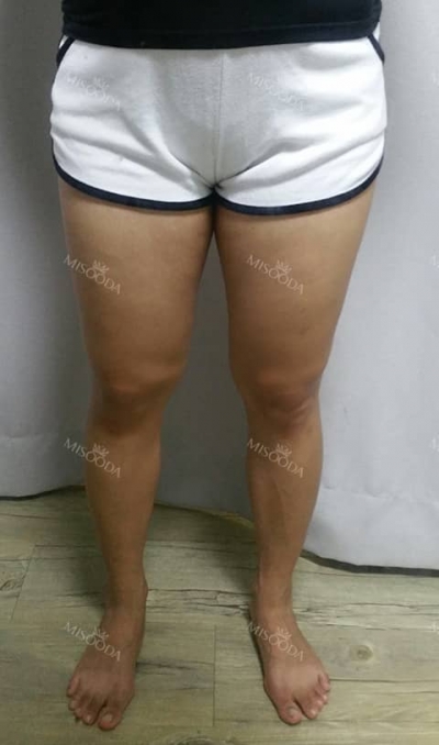 Rovl Avenue Liposuction,Reviews,Images, Promotions — Korea cost, reviews & before-after | MISOODA