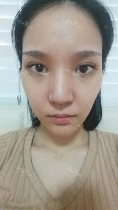 JW Plastic Surgery , Reviews, Images, Promotions — Korea cost, reviews & before-after | MISOODA