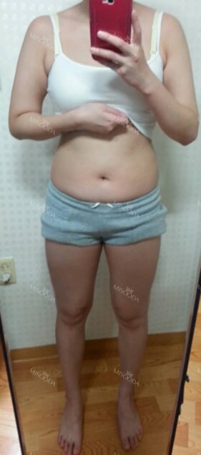 The Plastic Surgery, Reviews,Images, Promotions, — Korea cost, reviews & before-after | MISOODA