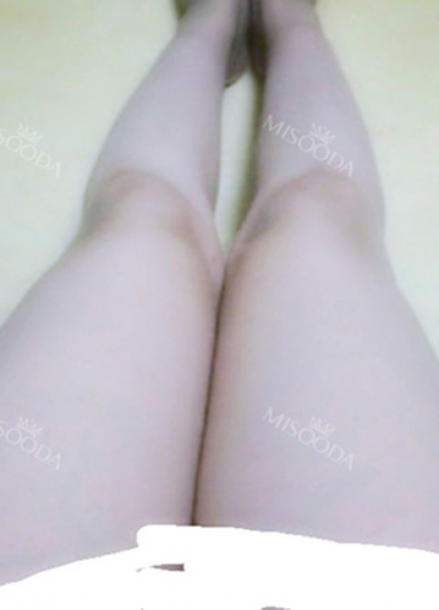 Rovl Avenue Liposuction,Reviews,Images, Promotions — Korea cost, reviews & before-after | MISOODA