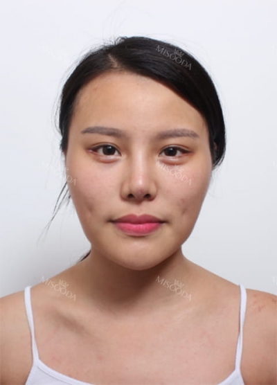 Deesse Plastic Surgery, Reviews,Images, Promotions — Korea cost, reviews & before-after | MISOODA