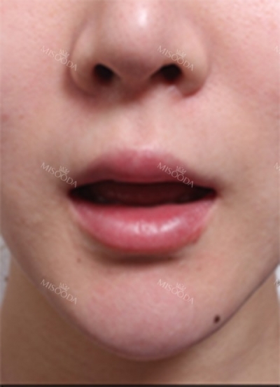 Deesse Plastic Surgery, Reviews,Images, Promotions — Korea cost, reviews & before-after | MISOODA