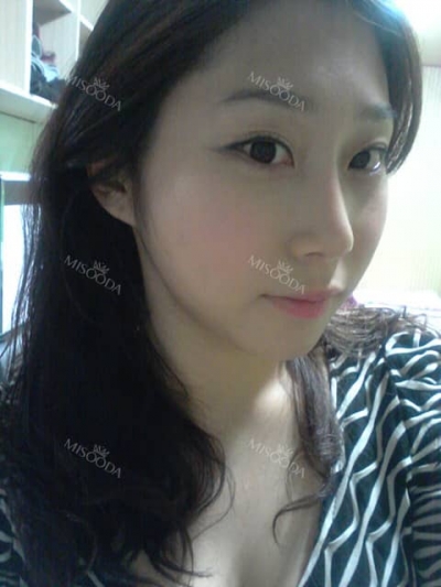 Romian Plastic Surgery, Reviews,Images, Promotions — Korea cost, reviews & before-after | MISOODA