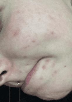HERSHE Plastic Surgery, Reviews,Images, Promotions — Korea cost, reviews & before-after | MISOODA