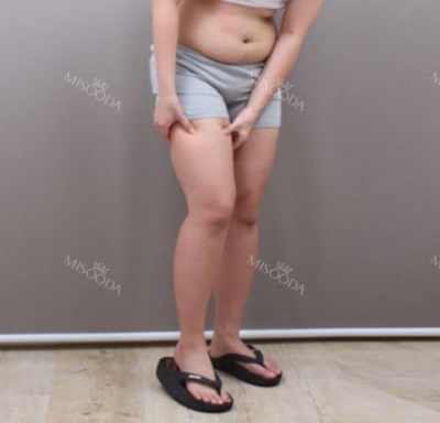 Seoul 365mc Liposuction,Reviews,Images, Promotions — Korea cost, reviews & before-after | MISOODA
