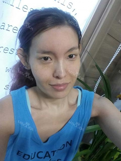 Jewelry Plastic Surgery,Reviews,Images, Promotions — Korea cost, reviews & before-after | MISOODA