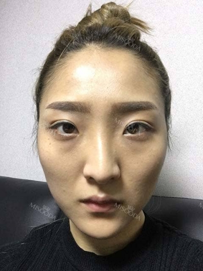 Jewelry Plastic Surgery,Reviews,Images, Promotions — Korea cost, reviews & before-after | MISOODA