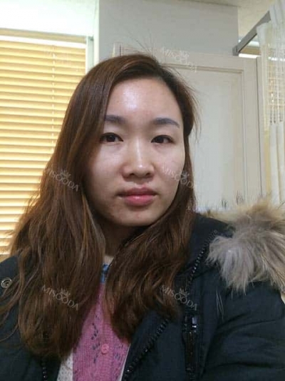 Jewelry Plastic Surgery,Reviews,Images, Promotions — Korea cost, reviews & before-after | MISOODA
