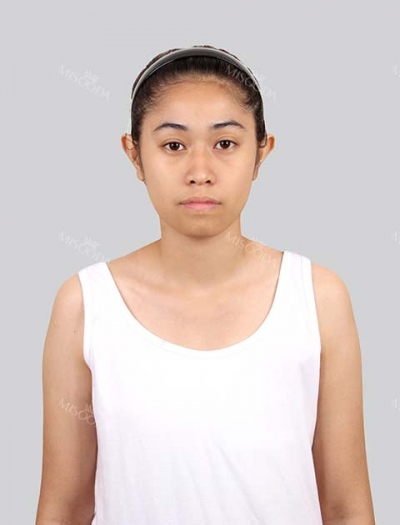 View Plastic Surgery, Reviews, Images, Promotions — Korea cost, reviews & before-after | MISOODA