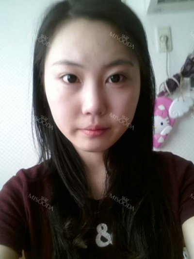 View Plastic Surgery, Reviews, Images, Promotions — Korea cost, reviews & before-after | MISOODA