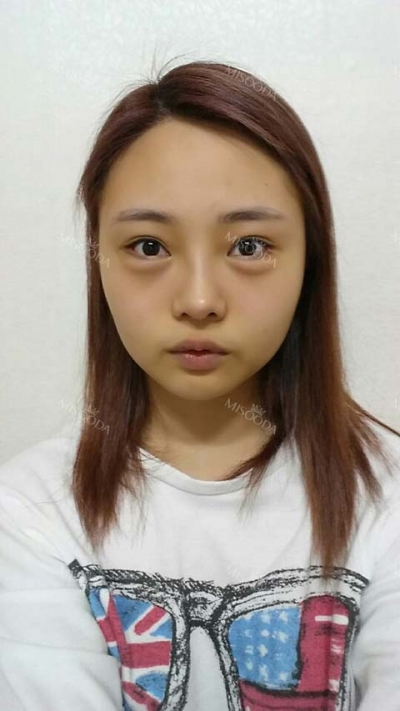 View Plastic Surgery, Reviews, Images, Promotions — Korea cost, reviews & before-after | MISOODA