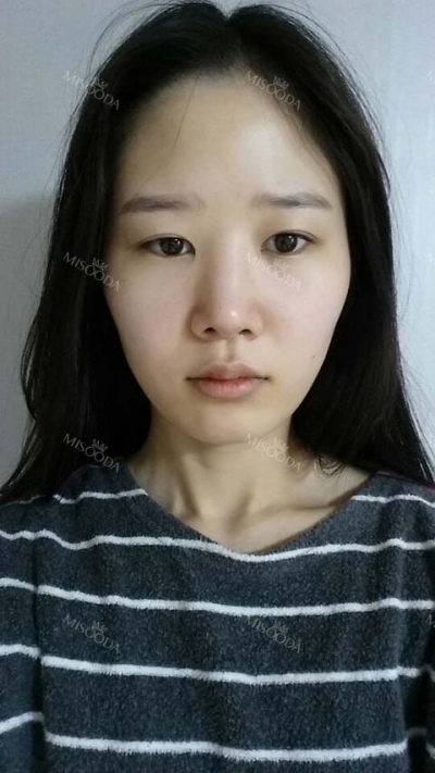 View Plastic Surgery, Reviews, Images, Promotions — Korea cost, reviews & before-after | MISOODA