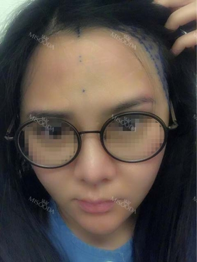 Yonsei Hair transplant Plastic Surgery, Reviews,Images, Promotions — Korea cost, reviews & before-after | MISOODA