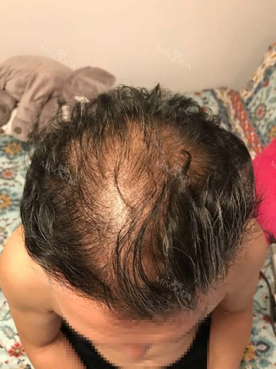Yonsei Hair transplant Plastic Surgery, Reviews,Images, Promotions — Korea cost, reviews & before-after | MISOODA