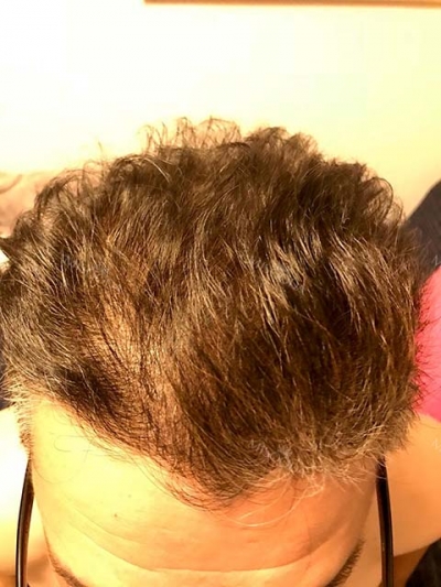 Yonsei Hair transplant Plastic Surgery, Reviews,Images, Promotions — Korea cost, reviews & before-after | MISOODA
