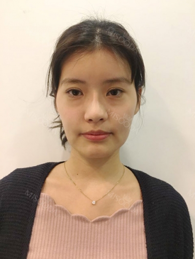 Jewelry Plastic Surgery,Reviews,Images, Promotions — Korea cost, reviews & before-after | MISOODA