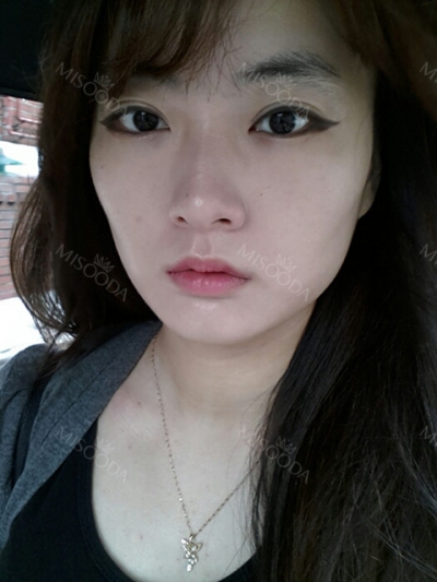 Jewelry Plastic Surgery,Reviews,Images, Promotions — Korea cost, reviews & before-after | MISOODA