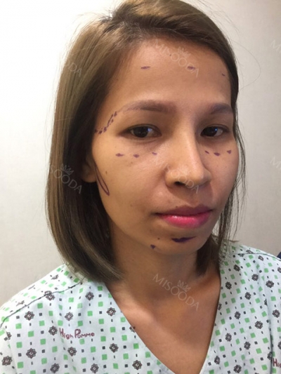 ts plastic surgery — Korea cost, reviews & before-after | MISOODA