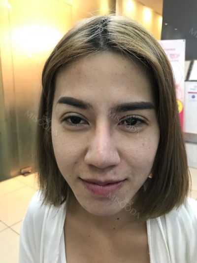 ts plastic surgery — Korea cost, reviews & before-after | MISOODA