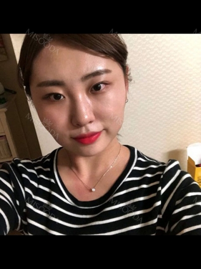 NANA Plastic Surgery,Reviews,Images, Promotions, MISOODA — Korea cost, reviews & before-after | MISOODA
