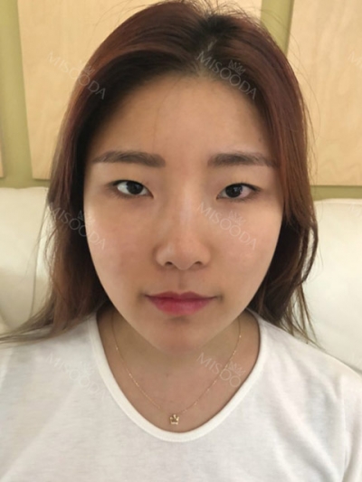 Jewelry Plastic Surgery,Reviews,Images, Promotions — Korea cost, reviews & before-after | MISOODA