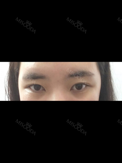 Jewelry Plastic Surgery,Reviews,Images, Promotions — Korea cost, reviews & before-after | MISOODA