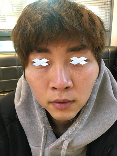 Jewelry Plastic Surgery,Reviews,Images, Promotions — Korea cost, reviews & before-after | MISOODA
