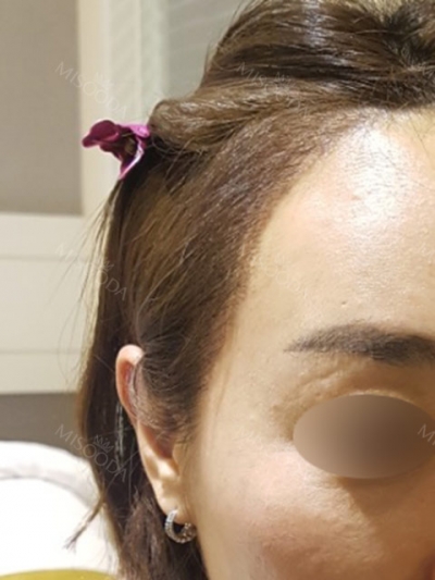 Yonsei Hair transplant Plastic Surgery, Reviews,Images, Promotions — Korea cost, reviews & before-after | MISOODA