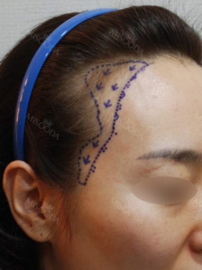 Yonsei Hair transplant Plastic Surgery, Reviews,Images, Promotions — Korea cost, reviews & before-after | MISOODA